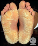 Keratosis Palmoplantaris