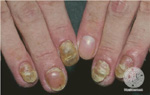 Psoriasis Vulgaris, Nail Changes