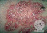 Tinea corporis