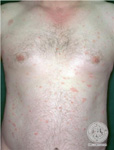 Pityriasis rosea