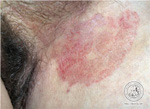 Tinea inguinalis