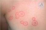 Tinea corporis