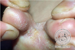 Tinea pedis