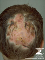 Tinea capitis