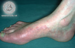 Tinea pedis