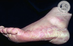 Tinea pedis