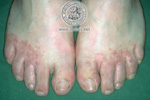 Tinea pedis