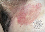 Tinea inguinalis