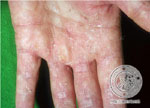 Tinea manuum
