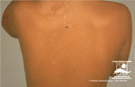 Tinea corporis