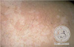 Tinea corporis