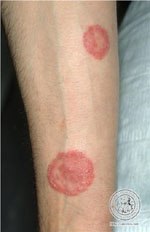 Tinea corporis