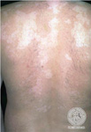 Pityriasis versicolor