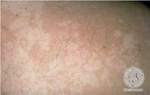 Pityriasis versicolor