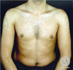 Pityriasis versicolor